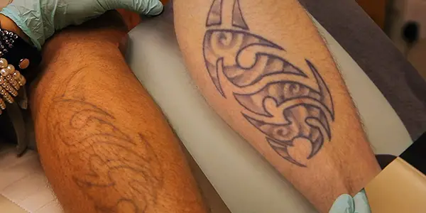 D'INKED - A TATTOO REMOVAL DOCUMENTARY: An Eye Opener D'INKED - A TATTOO REMOVAL DOCUMENTARY: An Eye Opener